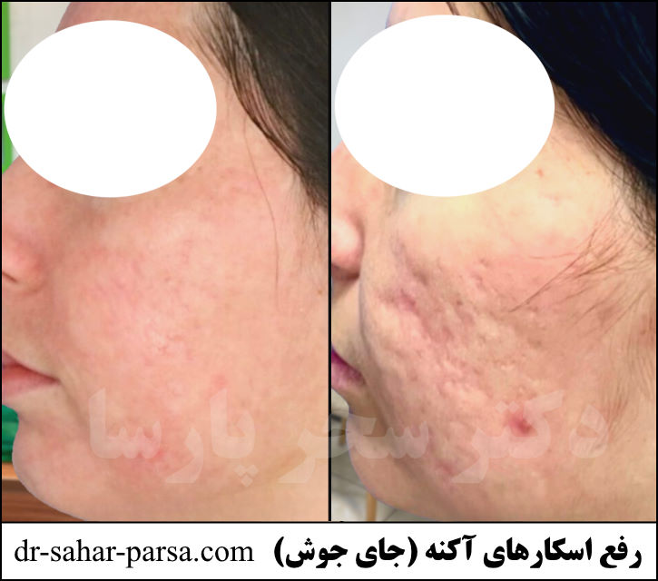 رفع اسکار جای جوش (آکنه) کلینیک زیبایی شرق تهران پیروزی