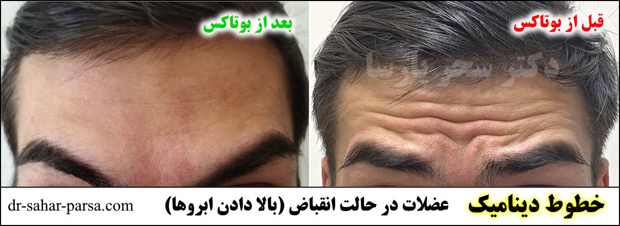 بهترین پزشک بوتاکس پیروزی