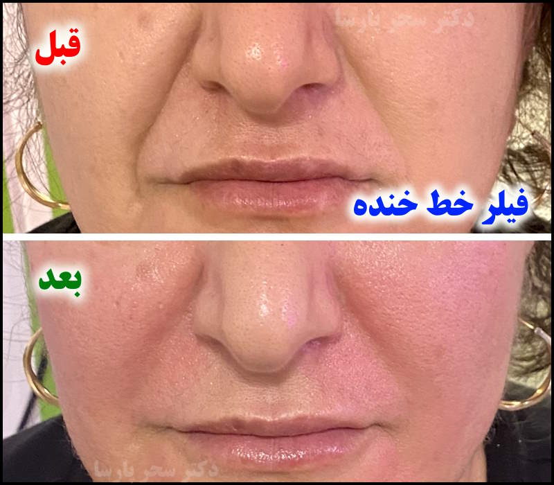 بهترین کلینیک تزریق فیلر (ژل) پیروزی