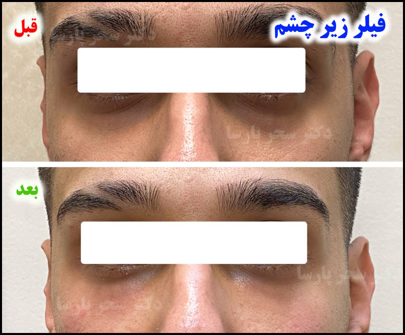 دکتر تزریق فیلر زیر چشم