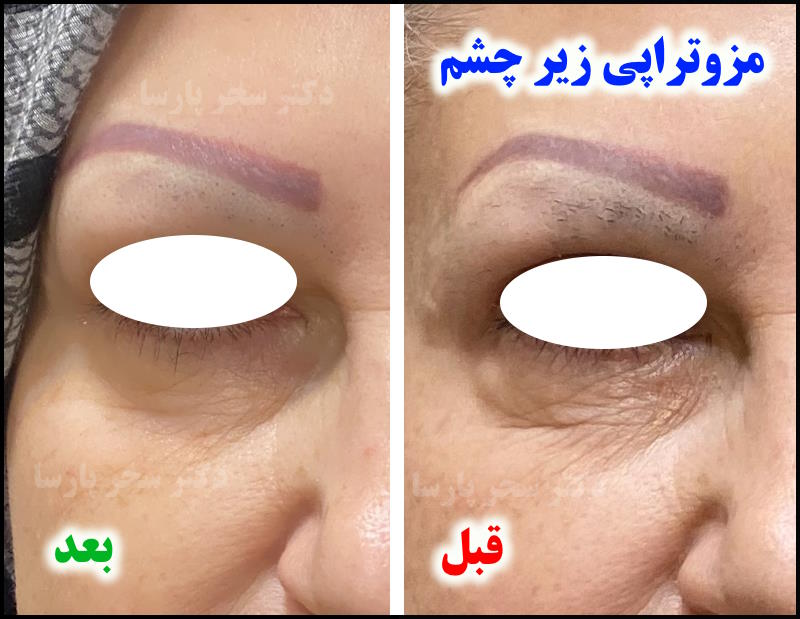 مزوتراپی زیر چشم