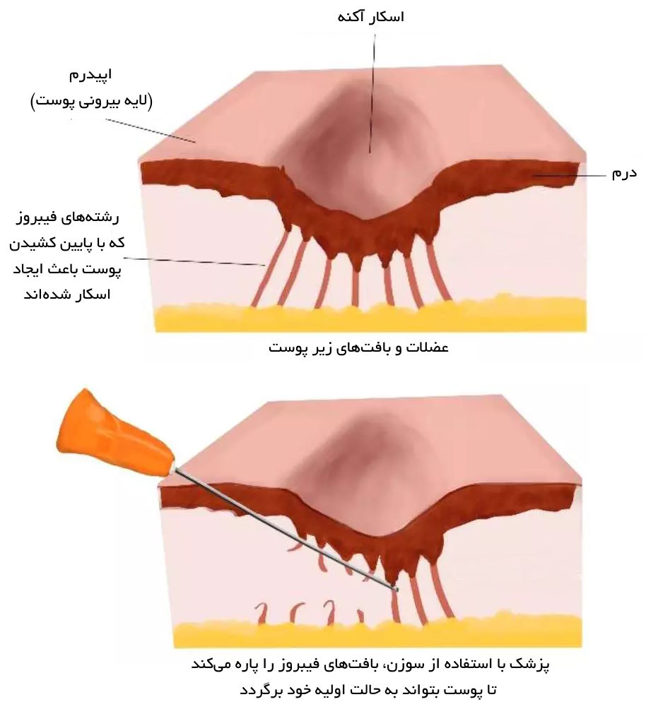 سابسیژن